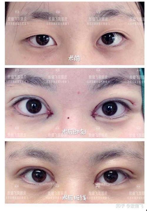 割双眼皮图片前后对比,见证美丽蜕变之旅